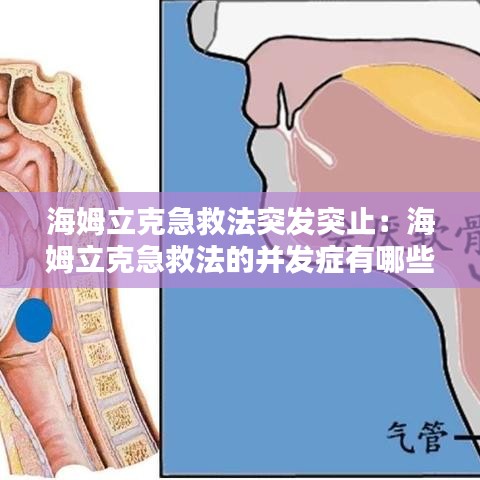 海姆立克急救法突发突止：海姆立克急救法的并发症有哪些? 