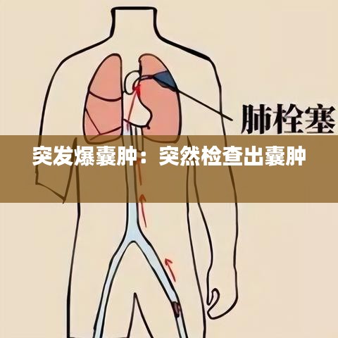 突发爆囊肿：突然检查出囊肿 