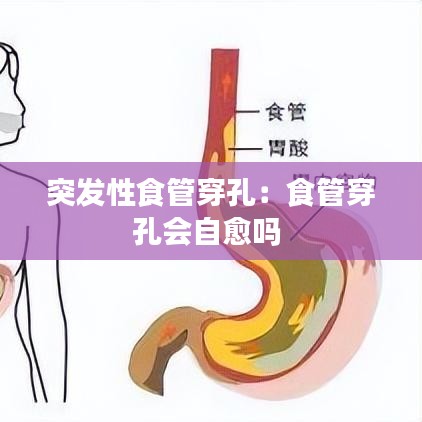 突发性食管穿孔：食管穿孔会自愈吗 